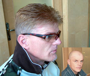 vorher nachher Toupet